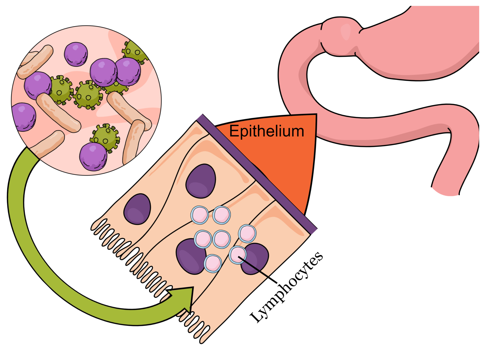 Lymphocytes infiltrating epithelium