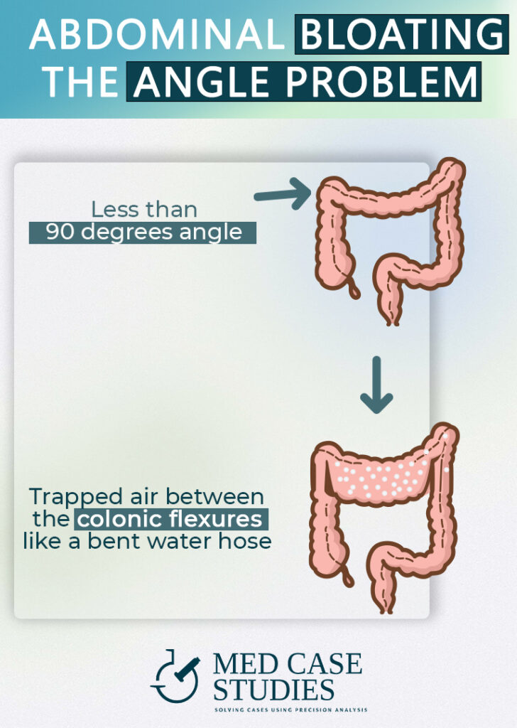 Abdominal-bloating-colon