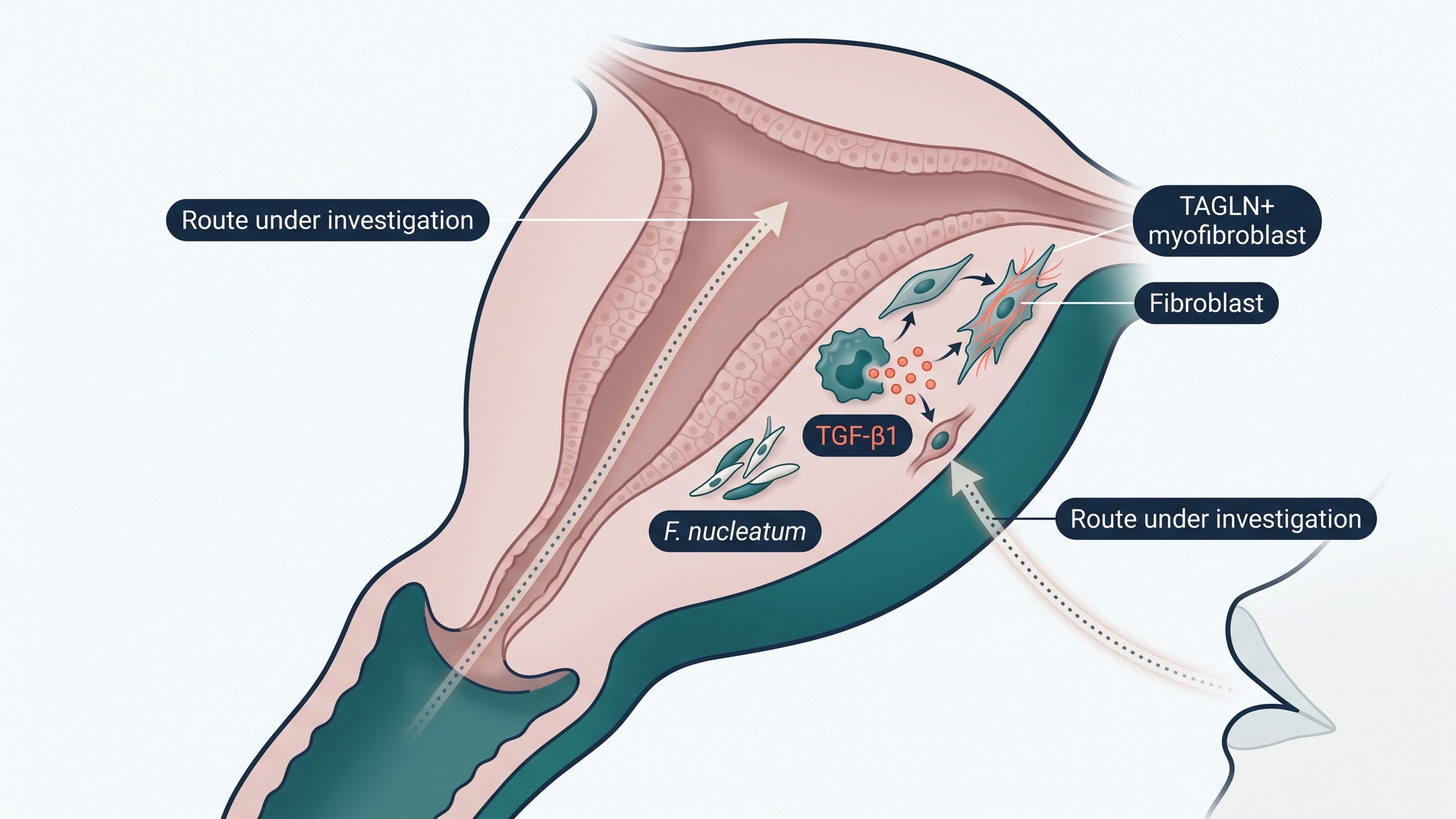 Scientific illustration of possible vaginal and bloodstream transfer of Fusobacterium to the uterine lining