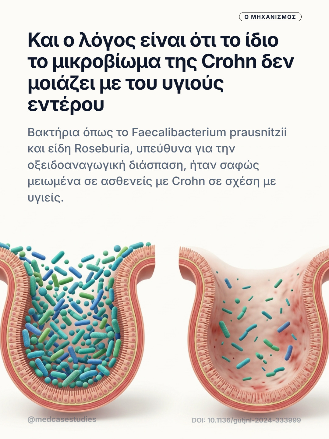Δύο εγκάρσιες τομές εντέρου συγκρίνουν πυκνό μικροβίωμα με αραιότερα βακτήρια και ερεθισμένο ιστό.