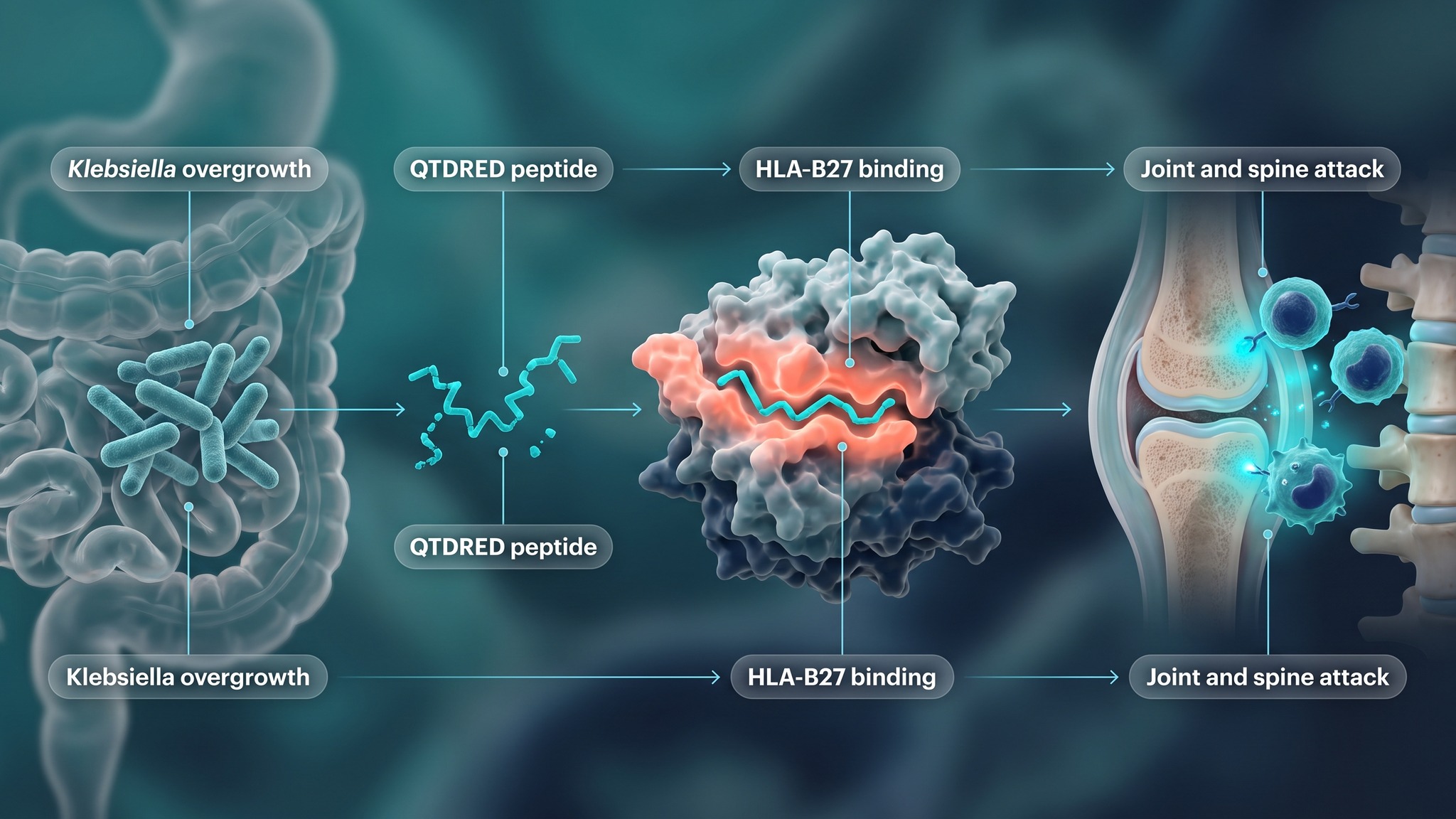 Biomedical pathway illustration of molecular mimicry, from Klebsiella overgrowth to QTDRED peptide binding HLA-B27 to joint and spine attack in ankylosing spondylitis