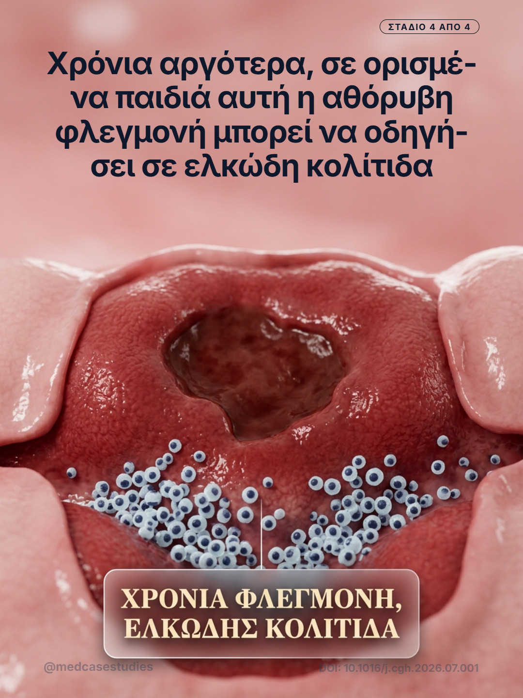 Τρισδιάστατη απεικόνιση ερυθρού φλεγμονώδους βλεννογόνου παχέος εντέρου με έλκος και συσσωρευμένα λευκά κύτταρα.