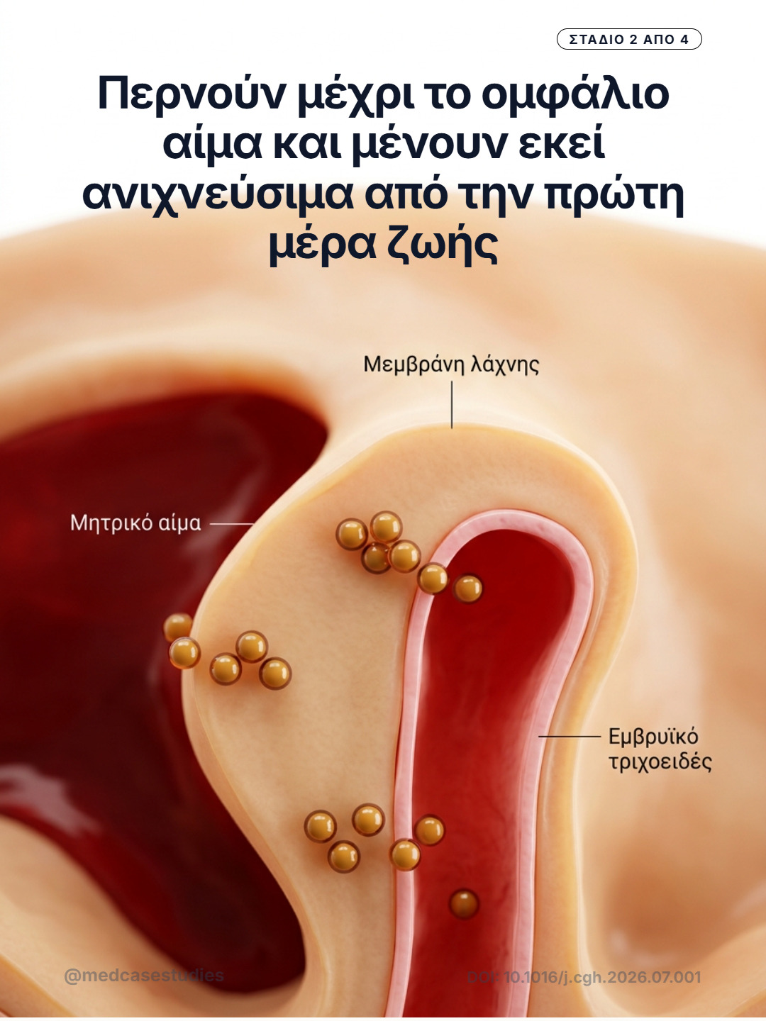 Ανατομική απεικόνιση πλακουντιακής λάχνης με μητρικό αίμα, εμβρυϊκό τριχοειδές και χρυσά σωματίδια που κατευθύνονται προς το αγγείο.