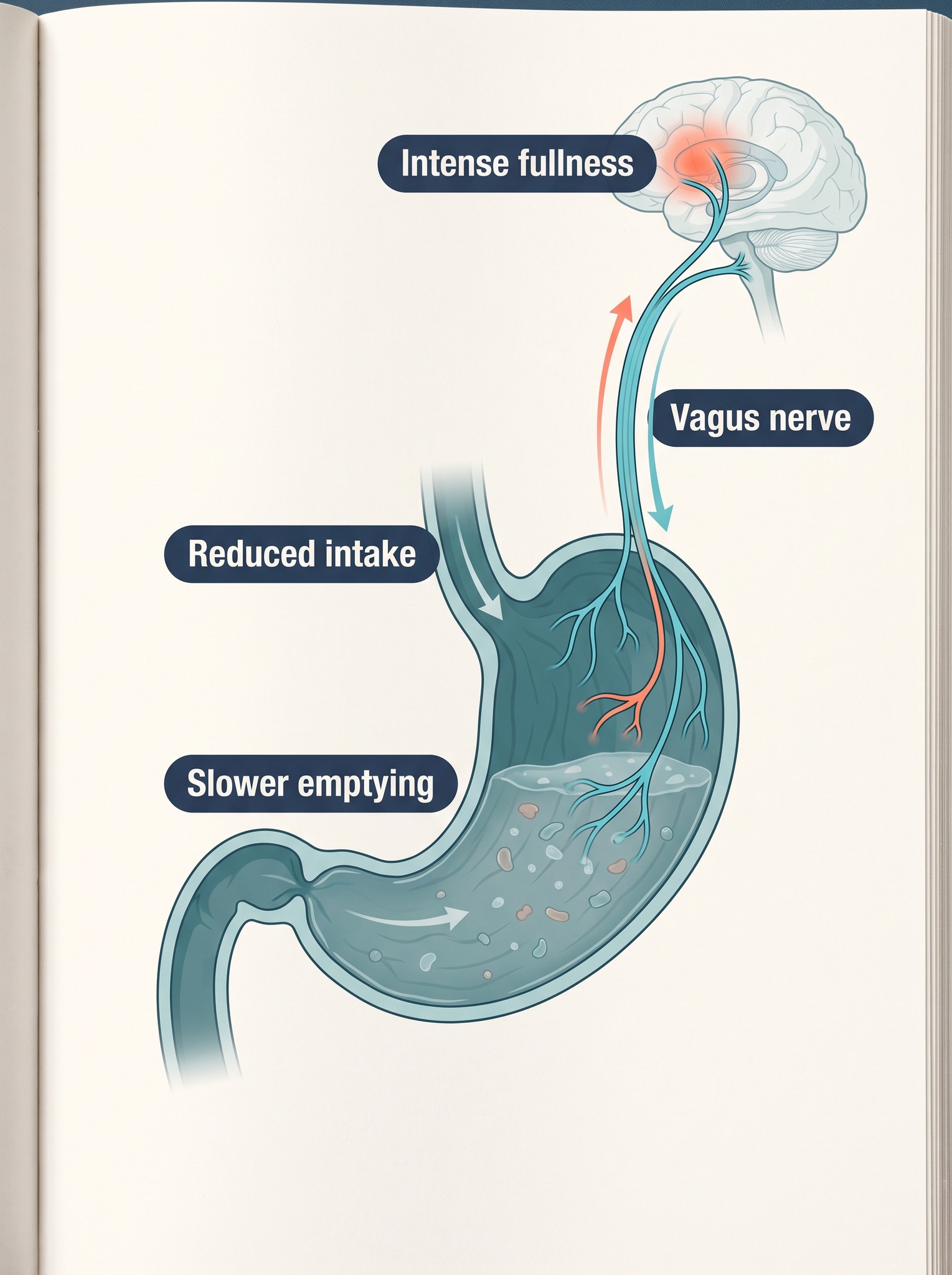 Diagram of slower gastric emptying and fullness signals travelling through the vagus nerve