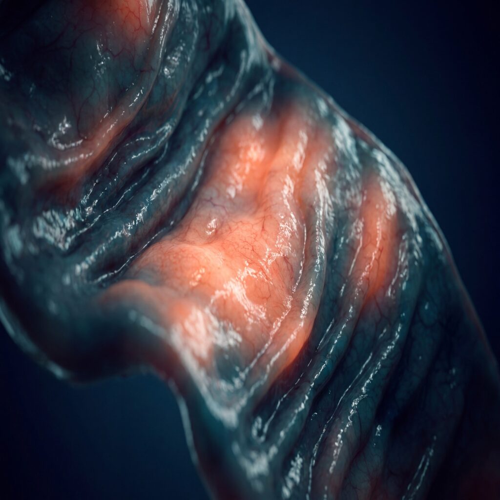 Artistic depiction of inflamed rectal mucosa in teal, navy, and coral tones