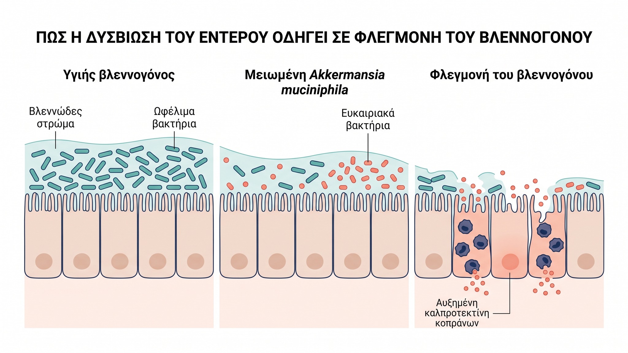 Διάγραμμα που δείχνει πώς τα ευρήματα της εξέτασης κοπράνων συνδέονται με τη φλεγμονή του εντέρου