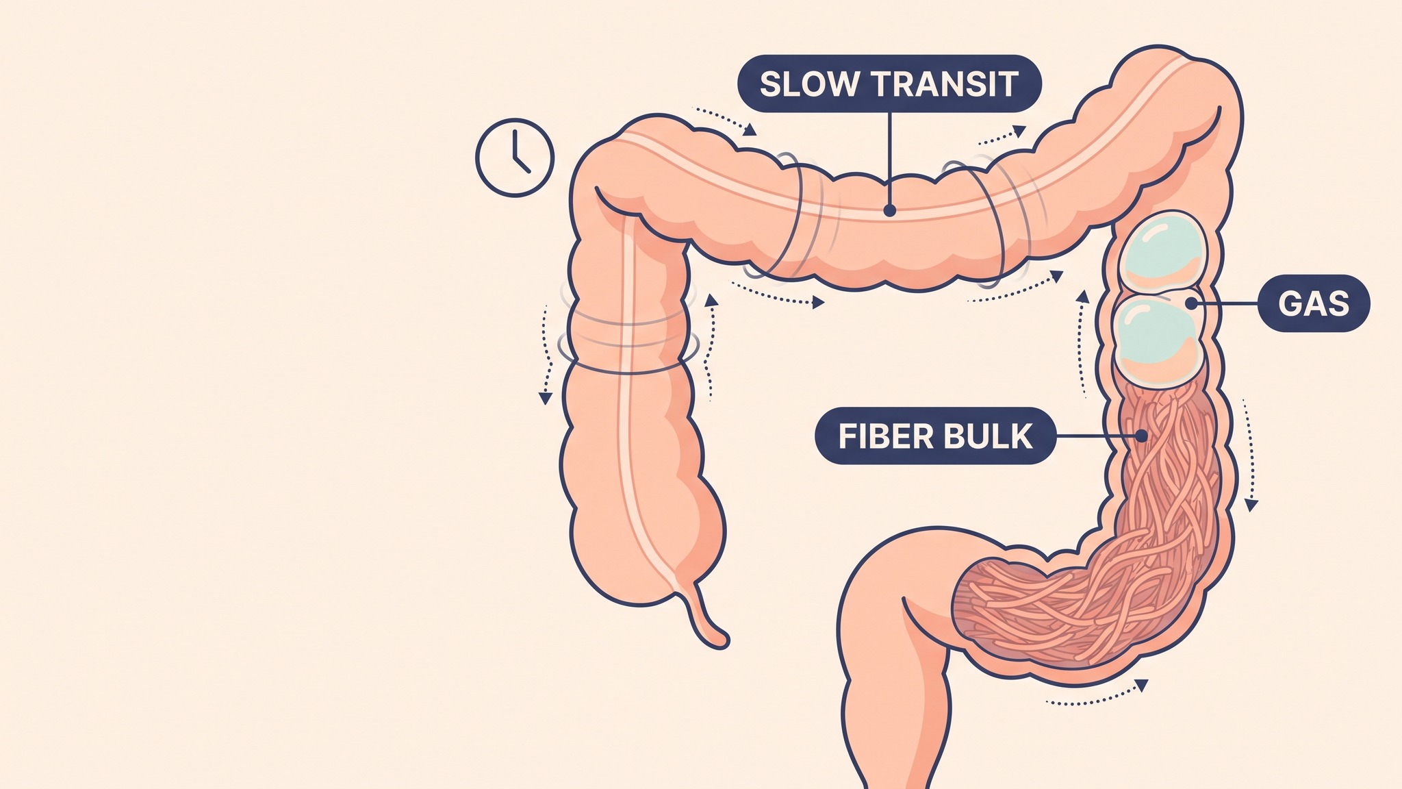 Fibermaxxing and slow transit, a sluggish colon holding a packed fiber mass with trapped gas pockets