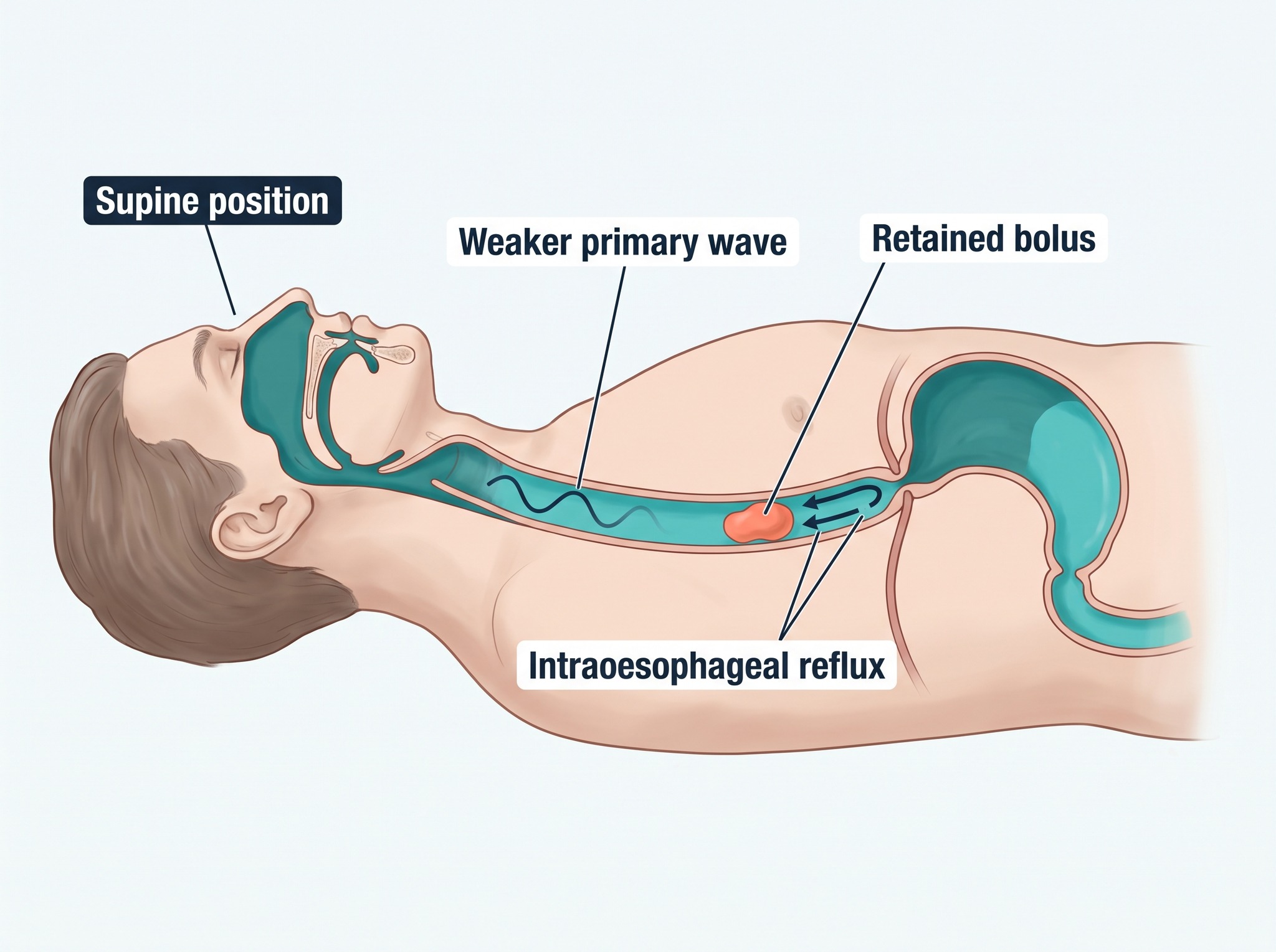Weaker supine oesophageal clearance with a retained bolus and intraoesophageal reflux